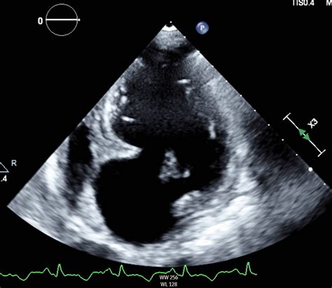 lv true aneurysm vs pseudoaneurysm|pseudoaneurysm vs true aneurysm echo.